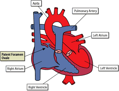 Diagram of a Heart with a PFO defect